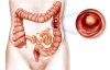 polyp đại tràng.jpg